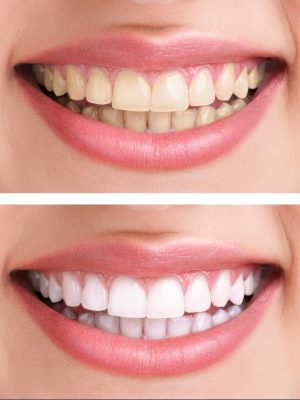 Smile Transformations
